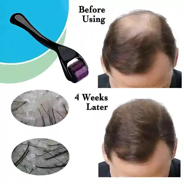 Before and after comparison of hair growth treatment with a roller device.