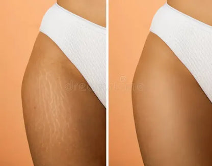Before and after comparison of a person's leg with visible stretch marks on an orange background.