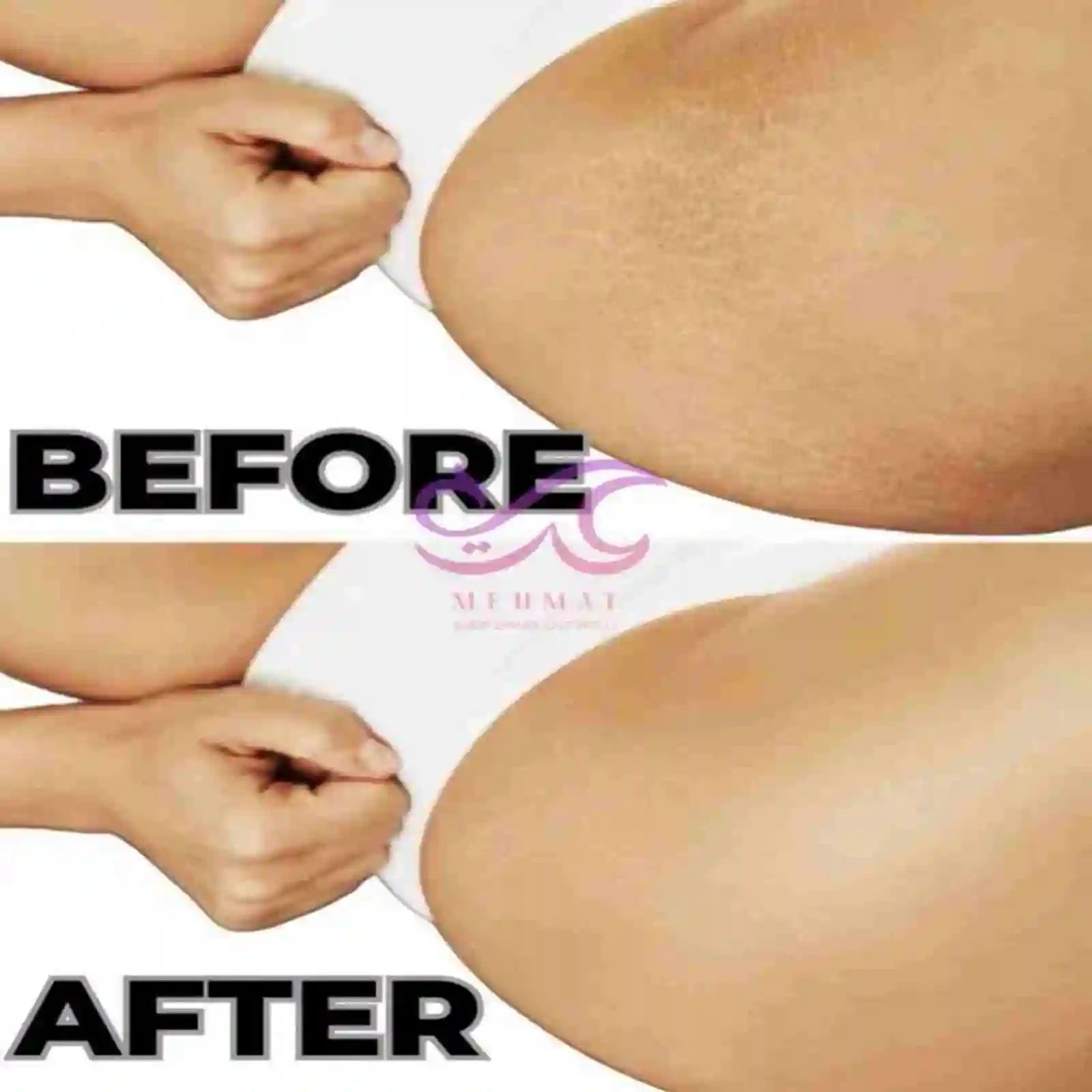 Before and after comparison of a person's legs with a visible brand logo.