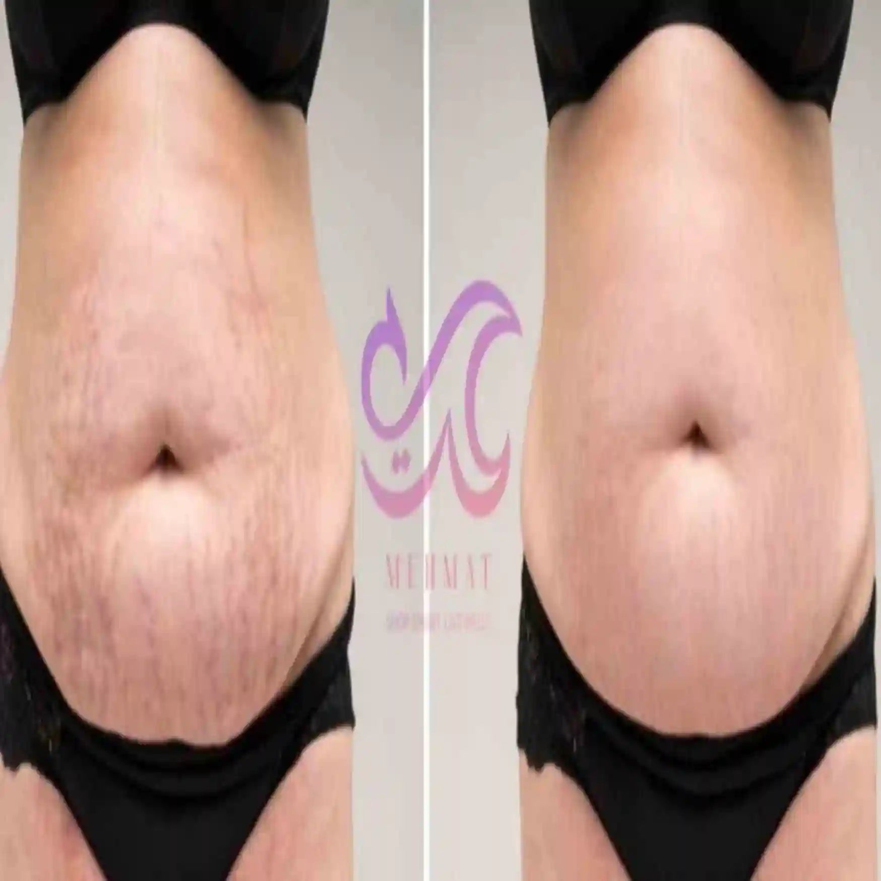 Before and after comparison of a person's abdomen with a visible brand logo.