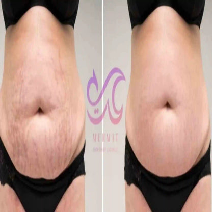Before and after comparison of a person's abdomen with a visible brand logo.