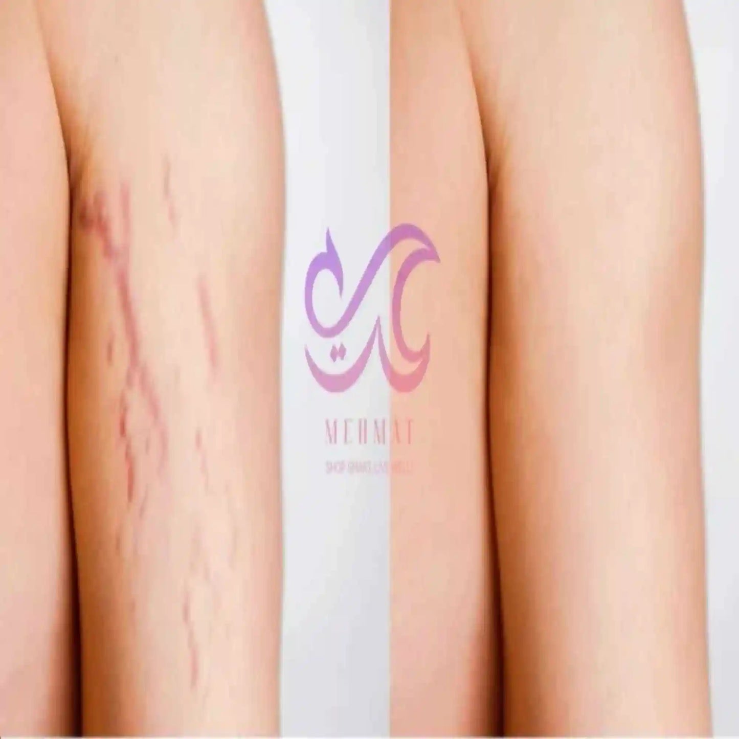 Before and after comparison of a scar removal treatment with a brand logo in the center.