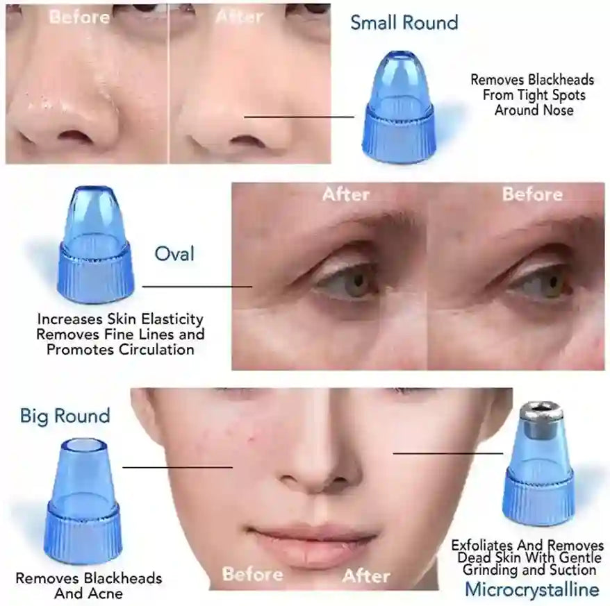 Before and after effects of a skin treatment device on different parts of the face.