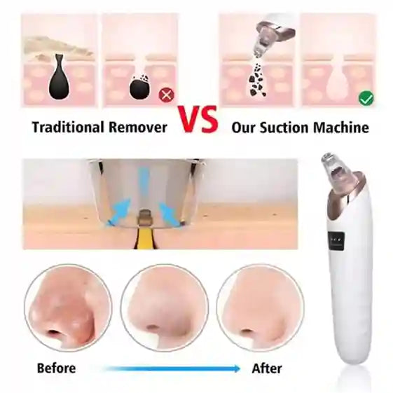 Comparison of traditional remover vs suction machine for hair removal, with before and after effects shown.
