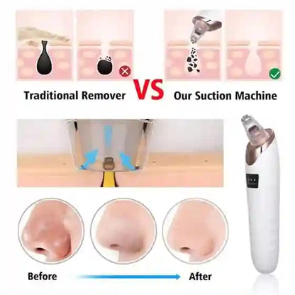 Comparison of traditional remover vs suction machine for hair removal, with before and after effects shown.