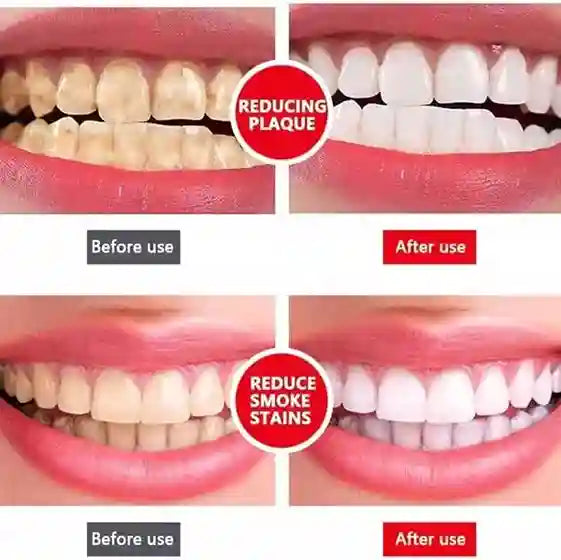 Before and after effect of using a teeth whitening product on plaque and smoke stains.