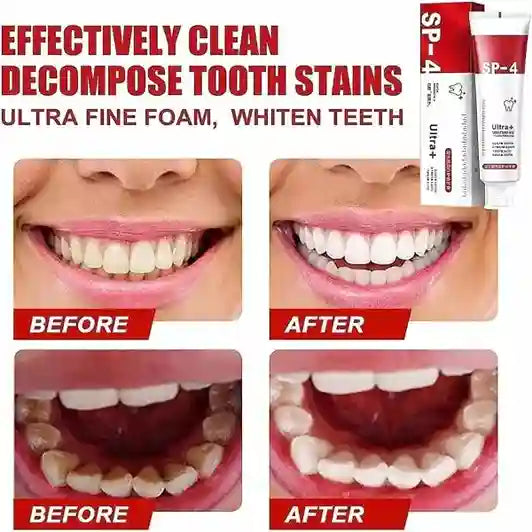 Before and after effects of a teeth whitening product with a tube labeled SP-4.